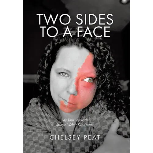 Two Sides to a Face: My Journey with Sturge Weber Syndrome
